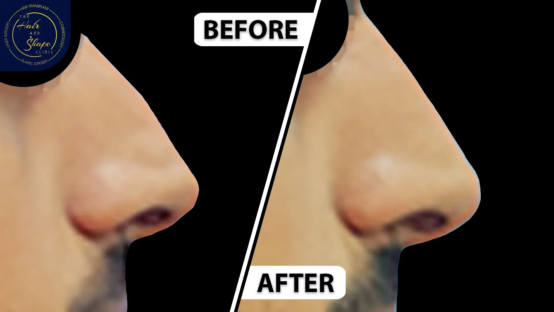 Rhinoplasty result13